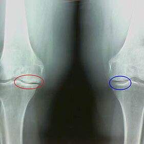 Arthrosis of the knee joint on the radiography
